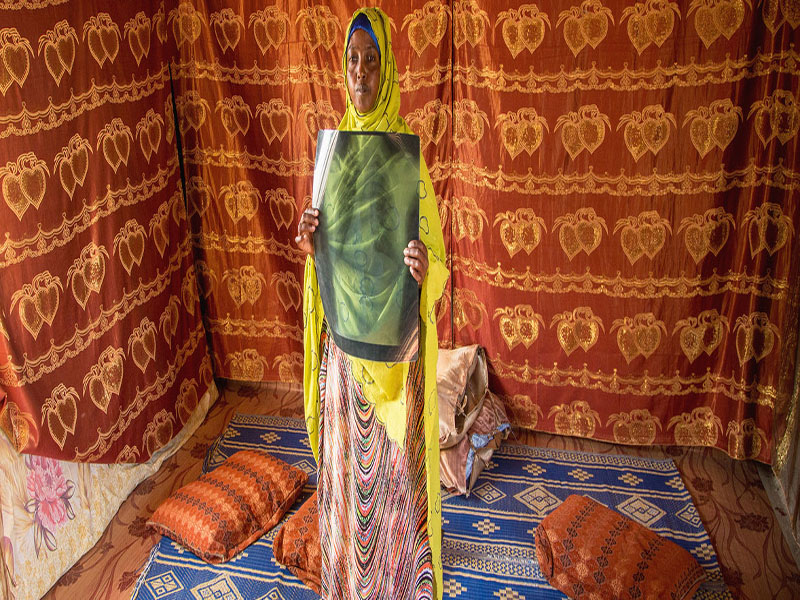 PNUD/Aurélia Rusek Una refugiada somalí a la que se le diagnosticó tuberculosis en 2017 muestra una radiografía de tórax en un campamento de Djibouti donde vive con su familia. PNUD/Aurélia Rusek Una refugiada somalí a la que se le diagnosticó tuberculosis en 2017 muestra una radiografía de tórax en un campamento de Djibouti donde vive con su familia.